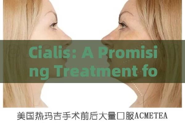 Cialis: A Promising Treatment for BPH,Title: Cialis for BPH Relief